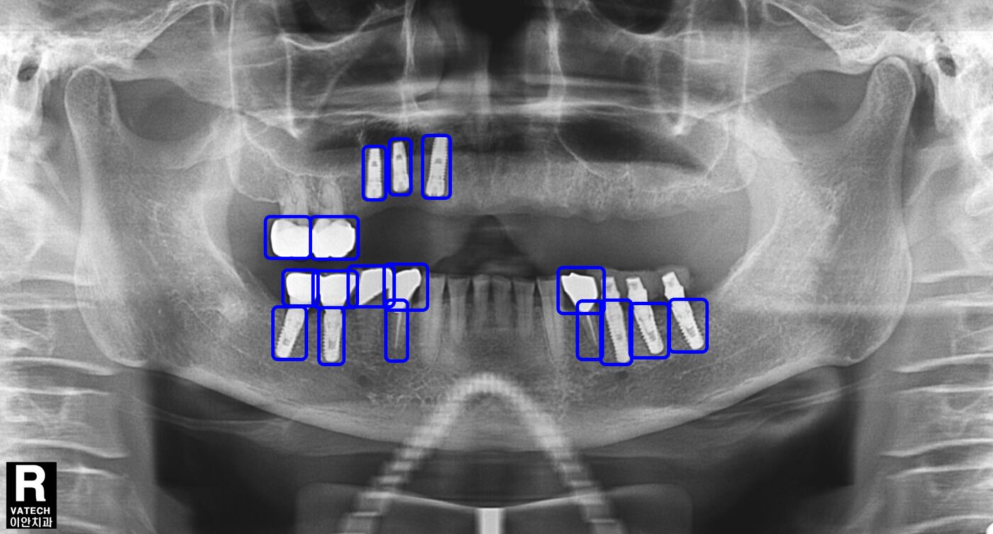 Radiografie panoramică analizată de AI — detectare automată a implanturilor dentare în Planodent